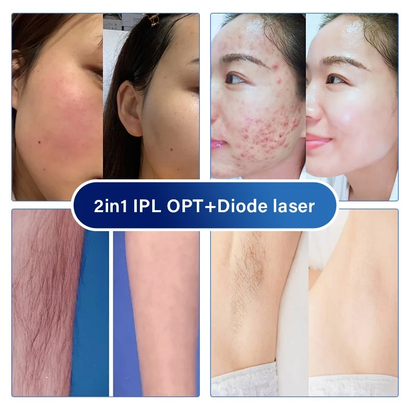 2IN1 IPL OPT+DIODE LASER price